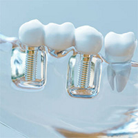 Установка имплантов Straumann  (Швейцария) в стоматологии «НИКА-МЕД» в Митино