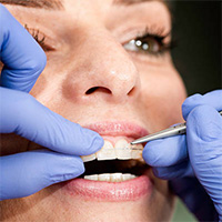 Преимущества самолигирующих брекетов