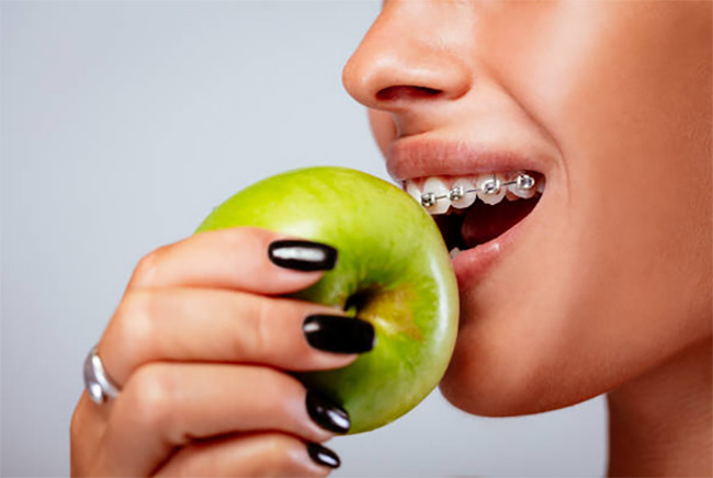 Лечение на брекет системе в рассрочку