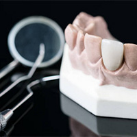 Особенности имплантов Straumann SLActive