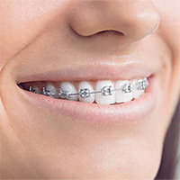 Преимущества и недостатки металлической лигатурной брекет-системы Victory