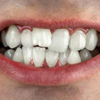 Исправление скученности зубов в стоматологии «НИКА-МЕД» в Митино